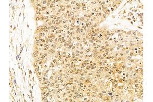 ABIN6263806 and ABIN6273061 at 1/100 staining Human esophageal cancer by IHC-P. (OIP5 anticorps  (C-Term))