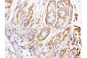Formalin-fixed and paraffin embedded human lung carcinoma labeled with Rabbit Anti NALP4 Polyclonal Antibody, Unconjugated (ABIN872353) at 1:200 followed by conjugation to the secondary antibody and DAB staining (NLRP4 anticorps  (AA 351-450))