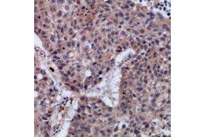 Immunohistochemical analysis of SETMAR staining in human lung cancer formalin fixed paraffin embedded tissue section. (SETMAR anticorps)