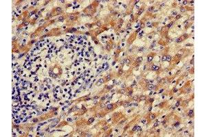 Immunohistochemistry of paraffin-embedded human liver cancer using ABIN7142472 at dilution of 1:100 (ALDH9A1 anticorps  (AA 12-144))