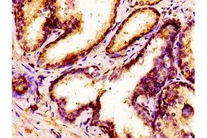 IHC image of ABIN7155804 diluted at 1:300 and staining in paraffin-embedded human prostate cancer performed on a Leica BondTM system.