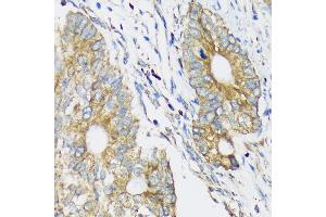 Immunohistochemistry of paraffin-embedded Human colon carcinoma using CLCC1 Rabbit pAb (ABIN7266333) at dilution of 1:100 (40x lens). (CLCC1 anticorps  (AA 302-501))