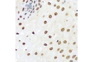 Immunohistochemical analysis of hnRNP A0 staining in human esophageal cancer formalin fixed paraffin embedded tissue section. (HNRNPA0 anticorps)