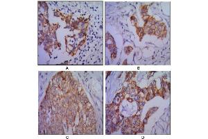 Immunohistochemical analysis of paraffin-embedded human lung cancer (A), colon cancer (B), ovarian cancer (C) and mammary cancer(D), using CDH2 antibody with DAB staining. (N-Cadherin anticorps)
