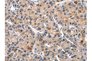 The image on the left is immunohistochemistry of paraffin-embedded Human liver cancer tissue using ABIN7190518(DUSP2 Antibody) at dilution 1/30, on the right is treated with synthetic peptide. (DUSP2 anticorps)