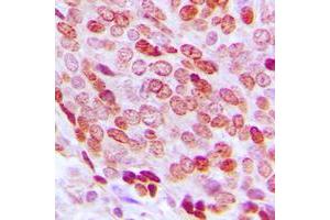 Immunohistochemical analysis of FOXD3 staining in human prostate cancer formalin fixed paraffin embedded tissue section.