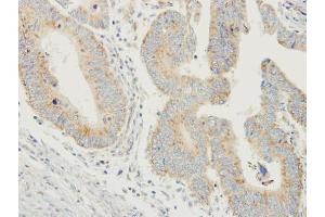 IHC-P Image Immunohistochemical analysis of paraffin-embedded human colon carcinoma, using PDYN, antibody at 1:250 dilution. (PDYN anticorps)