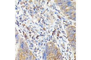 Immunohistochemistry of paraffin-embedded human colon carcinoma using T Rabbit pAb (ABIN3022236, ABIN3022237, ABIN3022238, ABIN1513586 and ABIN6218687) at dilution of 1:100 (40x lens). (TAP2 anticorps  (AA 430-680))