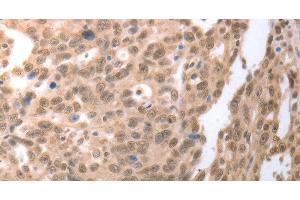 Immunohistochemistry of paraffin-embedded Human ovarian cancer tissue using RAD52 Polyclonal Antibody at dilution 1:50 (RAD52 anticorps)