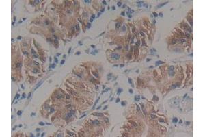 DAB staining on IHC-P; Samples: Human Stomach cancer Tissue