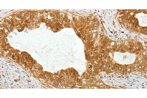 Immunohistochemistry of paraffin-embedded Human cervical cancer using TEKT1 Polyclonal Antibody at dilution of 1:30 (TEKT1 anticorps)