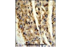 Formalin-fixed and paraffin-embedded human hepatocarcinoma reacted with DIO3 Antibody (C-term), which was peroxidase-conjugated to the secondary antibody, followed by DAB staining.