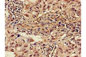 Immunohistochemistry of paraffin-embedded human lung cancer using ABIN7142600 at dilution of 1:100