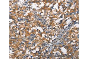 Immunohistochemistry of Human thyroid cancer using DDR2 Polyclonal Antibody at dilution of 1:40 (DDR2 anticorps)