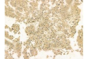 ABIN6263552 and ABIN6276984 at 1/100 staining human hepatocellular carcinoma by IHC-P. (Norrie Disease (Pseudoglioma) anticorps  (Internal Region))