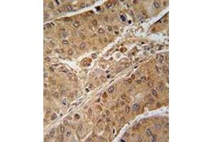 Immunohistochemical staining of formalin-fixed and paraffin-embedded human hepatocarcinoma reacted with RPS6KB2 monoclonal antibody  at 1:50-1:100 dilution. (RPS6KB2 anticorps)