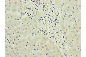 Immunohistochemistry of paraffin-embedded human liver cancer using ABIN7169283 at dilution of 1:100 (PPP2R3B anticorps  (Regulatory Subunit B))