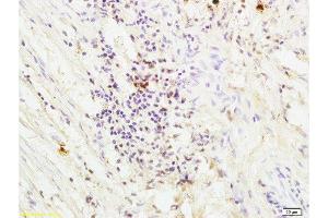 Formalin-fixed and paraffin embedded human colon carcinoma labeled with Anti-PAR-1 Polyclonal Antibody , Unconjugated at 1:200, followed by conjugation to the secondary antibody and DAB staining