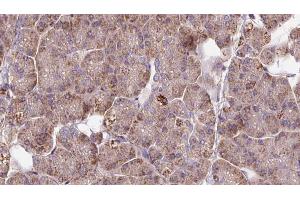 ABIN6273286 at 1/100 staining Human pancreas cancer tissue by IHC-P. (PAFAH2 anticorps  (Internal Region))