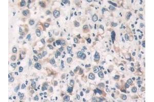 Detection of PAR4 in Human Stomach cancer Tissue using Polyclonal Antibody to Protease Activated Receptor 4 (PAR4)