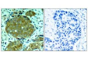 Immunohistochemical analysis of paraffin-embedded human breast carcinoma tissue using NFkB-p105(Phospho-Ser932) Antibody(left) or the same antibody preincubated with blocking peptide(right).