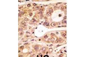 Formalin-fixed and paraffin-embedded human cancer tissue reacted with the primary antibody, which was peroxidase-conjugated to the secondary antibody, followed by AEC staining.