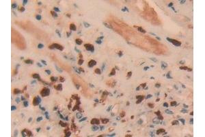 Detection of UCHL1 in Human Prostate cancer Tissue using Polyclonal Antibody to Ubiquitin Carboxyl Terminal Hydrolase L1 (UCHL1)