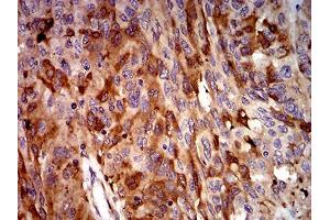 Immunohistochemical analysis of paraffin-embedded ovarian cancer tissues using C3C mouse mAb with DAB staining. (Complement C3c anticorps  (AA 1521-1649))
