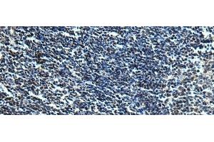 Immunohistochemistry of paraffin-embedded Human tonsil tissue using SLC2A12 Polyclonal Antibody at dilution of 1:30(x200) (GLUT12 anticorps)