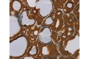 Immunohistochemistry of Human liver cancer using PARP3 Polyclonal Antibody at dilution of 1:40 (PARP3 anticorps)