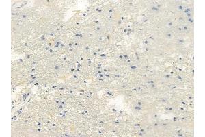ABIN6261314 and ABIN6266687 at 1/100 staining human glioblastoma by IHC-P. (DLGAP1 anticorps  (Internal Region))
