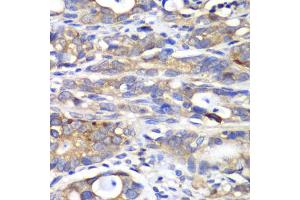 Immunohistochemistry of paraffin-embedded human gastric cancer using HAPLN1 antibody. (HAPLN1 anticorps)
