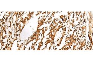 Immunohistochemistry of paraffin-embedded Human lung cancer tissue using TERF1 Polyclonal Antibody at dilution of 1:30(x200) (TRF1 anticorps)