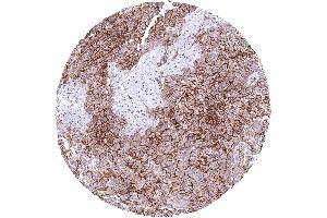 Lung Malignant mesothelioma with strong CD141 immunostaining of tumor cells CD141 immunohistochemistry. (Recombinant Thrombomodulin anticorps  (AA 69-194))