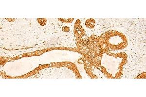Immunohistochemistry of paraffin-embedded Human ovarian cancer tissue using KRT76 Polyclonal Antibody at dilution of 1:50(x200)