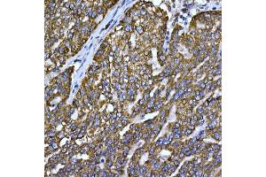 Immunohistochemistry of paraffin-embedded human oophoroma using Cytochrome C Rabbit pAb (ABIN3020718, ABIN3020719, ABIN3020720, ABIN1512803 and ABIN6213689) at dilution of 1:150 (40x lens).