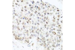 Immunohistochemistry of paraffin-embedded human lung cancer using CETN3 antibody.