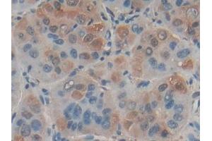 Detection of FASL in Human Liver cancer Tissue using Polyclonal Antibody to Factor Related Apoptosis Ligand (FASL)