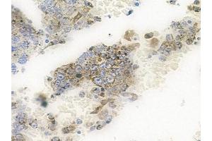 ABIN6261848 and ABIN6266490 at 1/100 staining human melanoma by IHC-P.