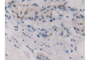 Detection of GR in Human Breast cancer Tissue using Polyclonal Antibody to Glutathione Reductase (GR)