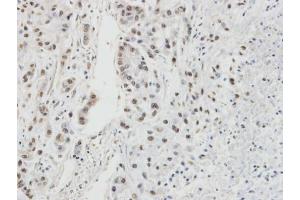 IHC-P Image Immunohistochemical analysis of paraffin-embedded A549 xenograft, using RPA32/RPA2, antibody at 1:100 dilution. (RPA2 anticorps)