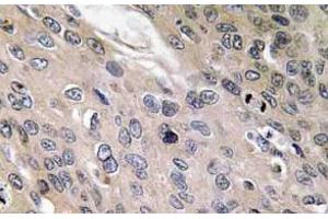 Immunohistochemistry (IHC) analyzes of BMP-6 antibody in paraffin-embedded human lung carcinoma tissue. (BMP6 anticorps)