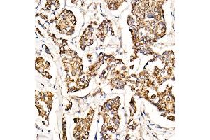Immunohistochemistry of paraffin-embedded human breast cancer using [KO Validated] MyD88 Rabbit mAb (ABIN7268723) at dilution of 1:1000 (40x lens).