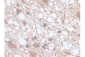 Detection of UCP2 in Human Glioma Tissue using Monoclonal Antibody to Mitochondrial Uncoupling Protein 2 (UCP2)