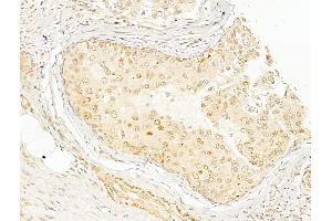 ABIN6255153 and ABIN6267596 at 1/100 staining Human breast cancer by IHC-P.