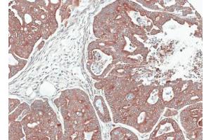 IHC-P Image Immunohistochemical analysis of paraffin-embedded gastric cancer N87 xenograft, using NOV, antibody at 1:100 dilution.