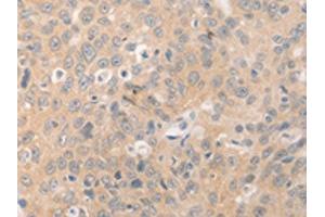 The image on the left is immunohistochemistry of paraffin-embedded Human ovarian cancer tissue using ABIN7189978(BEST1 Antibody) at dilution 1/20, on the right is treated with synthetic peptide. (Bestrophin 1 anticorps)