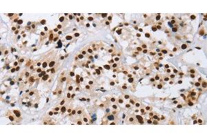 Immunohistochemistry of paraffin-embedded Human thyroid cancer using IL17C Polyclonal Antibody at dilution of 1:50 (IL17C anticorps)