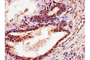 Immunohistochemistry of paraffin-embedded human prostate cancer using ABIN7168587 at dilution of 1:100 (SPDEF/PSE anticorps  (AA 145-247))