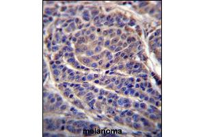 CA6 Antibody (C-term) (ABIN656592 and ABIN2845853) immunohistochemistry analysis in formalin fixed and paraffin embedded human melanoma followed by peroxidase conjugation of the secondary antibody and DAB staining. (CA6 anticorps  (C-Term))